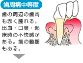歯周病中等度